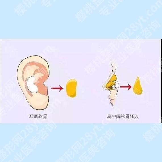 上海微加医疗美容门诊部做鼻子多少钱?价格费用明细\真人案例反馈