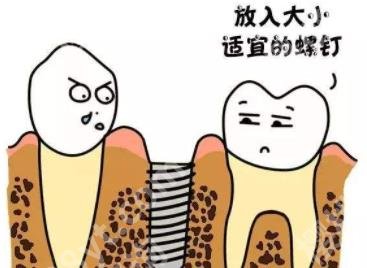上海正夫口腔正畸医生谁的技术好？技术优势对比！种植牙案例