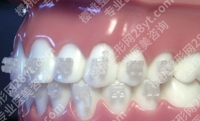 上海卓信口腔门诊部正畸怎么样？真人案例及收费情况介绍