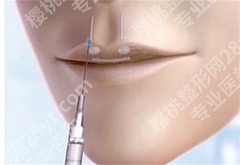 上海华美整形丰唇大概要多少钱?价目表公布,附注射丰唇案例