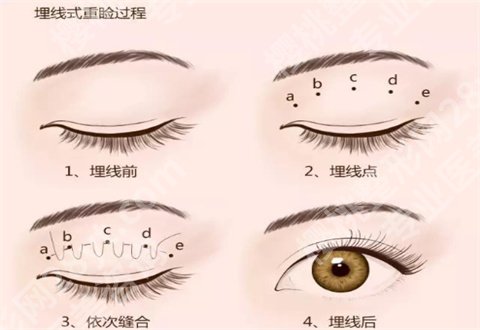 上海华美做眼综合怎么样？专家带你了解特色项目适合人群