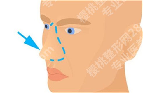 上海殷初阳医生怎么样？口碑技术好吗？附相关案例，细节曝光