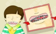 上海易美口腔门诊部正畸多少钱？收费贵不贵？相关项目科普