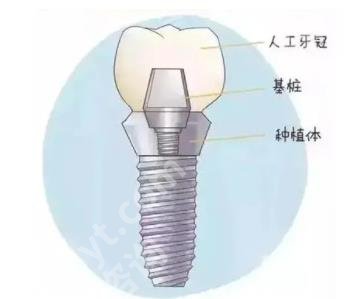 上海存济口腔医院种植牙多少钱?位置在哪里?种植牙好处介绍
