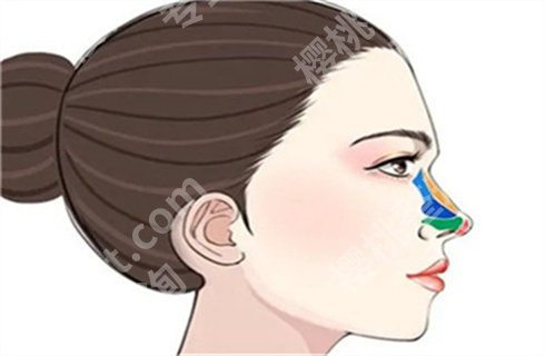 北京垫鼻子多少钱?垫鼻子哪种方式更好?术前预览详情