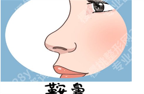 北京垫鼻子多少钱?垫鼻子哪种方式更好?术前预览详情