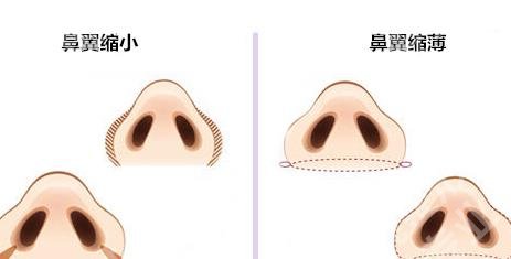 上海曹芳鼻子修复的图片|隆鼻项目科普！价格表参考