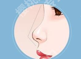 上海曹芳鼻子修复的图片|隆鼻项目科普！价格表参考