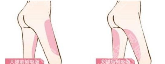 徐怀河医生大腿抽脂怎么样？技术优势是什么？案例参考