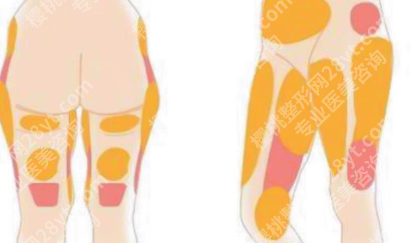 徐怀河医生大腿抽脂怎么样？技术优势是什么？案例参考