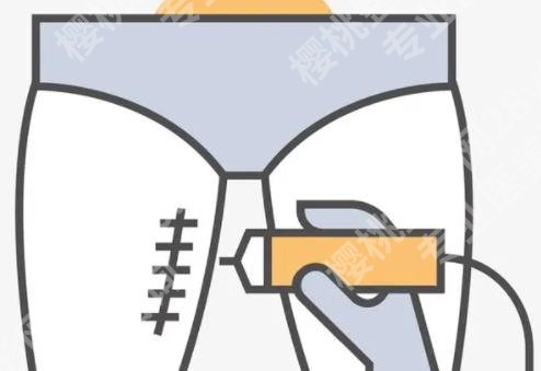 徐怀河医生大腿抽脂怎么样？技术优势是什么？案例参考