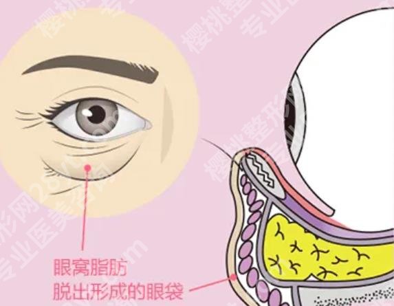 上海朴相根简介|目前就职于哪家医院？眼袋案例