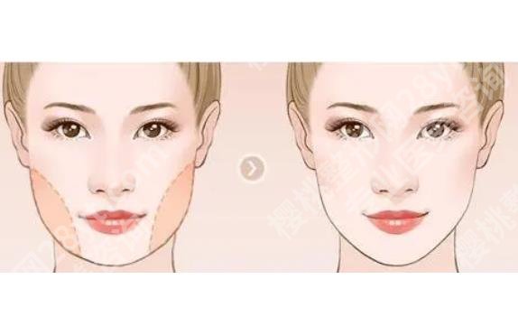 脸部抽脂手术多久消肿 ？脸部抽脂手术有风险吗？速速查看