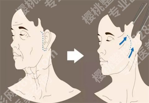 做一次热玛吉多少费用?会不会有疼痛感?有需求着速速点进来