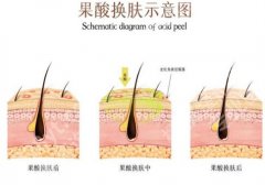果酸的作用有哪些？操作流程复杂吗？整理相关知识点