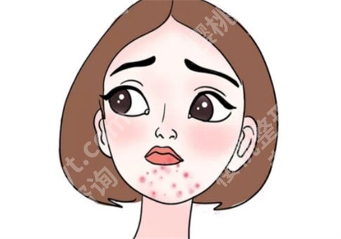 下巴长痘痘是什么原因？饮食该吃什么？集合解答