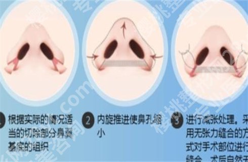 缩小鼻翼鼻头手术价格？细节介绍，详情点击查询！