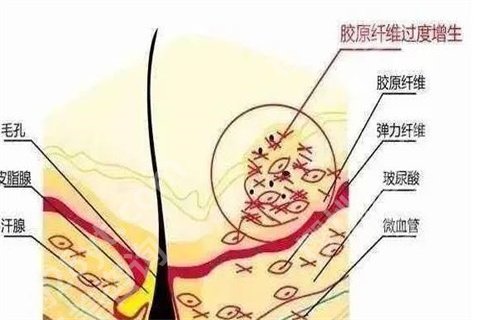 凹陷性疤痕怎样调节？如何修复，这些小秘方你知道吗？