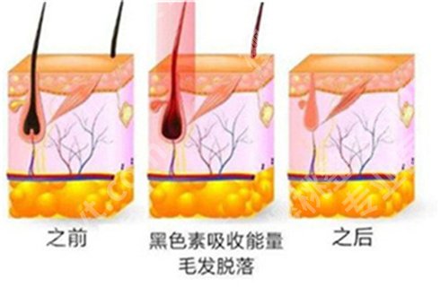 冰点激光脱毛效果？可以维持多久？相关介绍值得收藏！