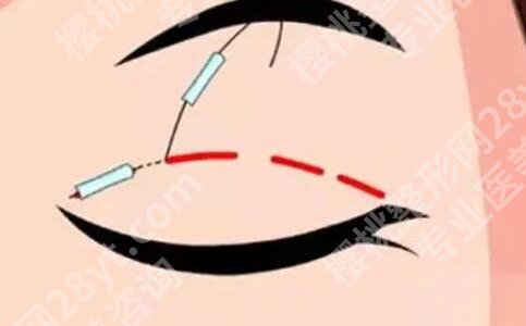 伊莱美朱迪医生的案例图来袭！内附网友双眼皮真实经历！
