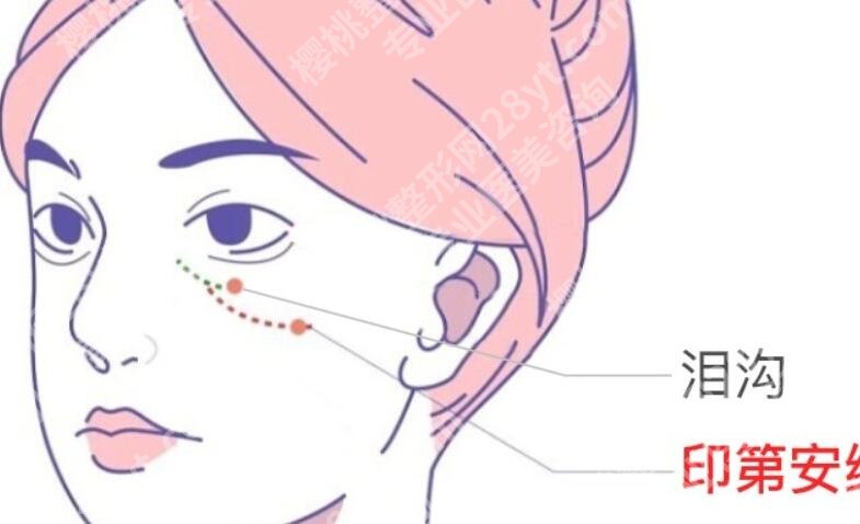 上海美莱袁玉坤的口碑怎么样？真人脂肪填充案例：后悔没早来！
