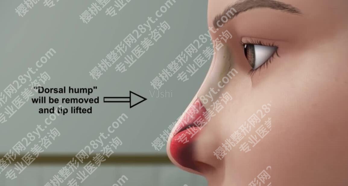 许炎龙做鼻子怎么样？网友隆鼻案例图展示：公布恢复过程！