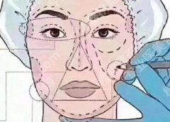 面中凹陷怎么改良？费用贵不贵？术后如何护理呢？