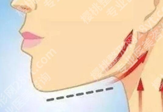 脸部轮廓固定怎么做？可以维持多久？有什么后遗症吗？