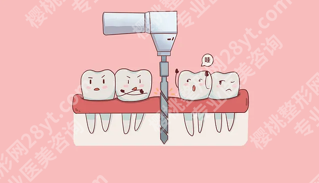 20岁种牙好还是镶牙好？了解这两种方法的特点和适用情况很重要！