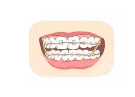 补三颗牙齿大概多少钱左右？咨询牙科医生获取专业的建议可以了解更多！