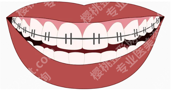 广州矫正牙齿多少钱？矫正牙齿的价格是因人而异的！