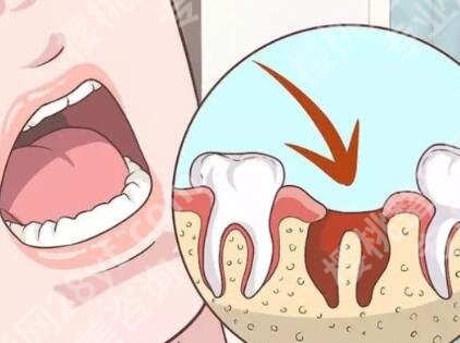 烤瓷牙齿多少钱一颗？让牙齿看起来更加美观自然！