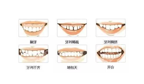 烤瓷牙的寿命是几年？质量差的瓷质容易脱落或破损！