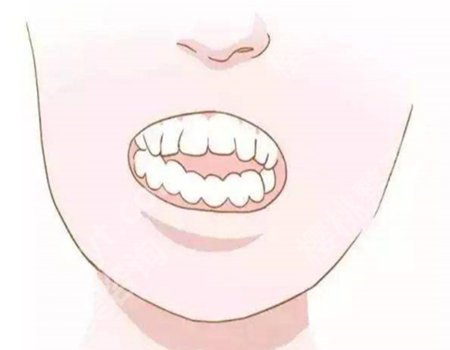 门牙有缺口怎么修复？修复后的牙齿表面光滑平整！