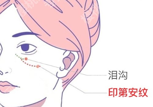 印第安纹和泪沟的区别有哪些？怎么去除更好？