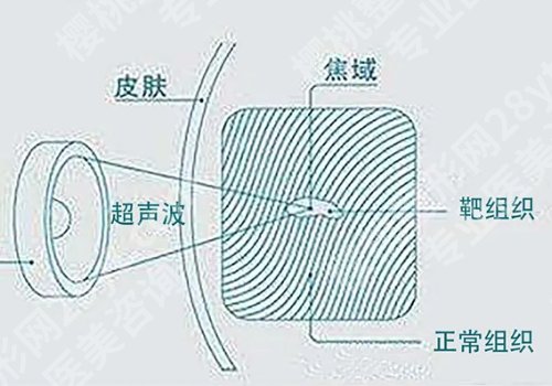 口周抗衰做什么医美？热玛吉、热拉提等都是不错的选择