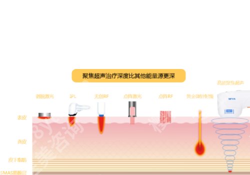 黄金超声炮和超声炮有什么区别？两项手术各有利弊