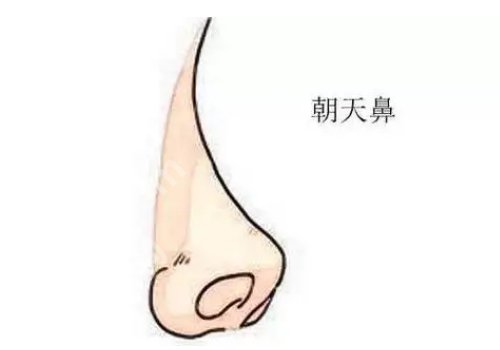 朝天鼻手术需要多少钱？价格详情解析，适应症有哪些？