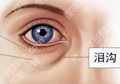 眼窝凹陷用什么填充好？手术详情一览