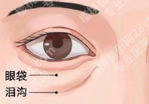 眼窝凹陷用什么填充好？手术详情一览