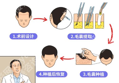 植鬓角真的有用吗？术后怎么去护理？