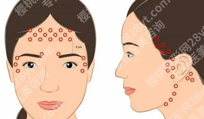 筋膜悬吊面部提升术保持多久？原理是什么呢？恢复期多久