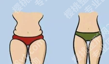 腰腹环吸抽脂需要多久恢复期|多会可以消肿呢？收费表