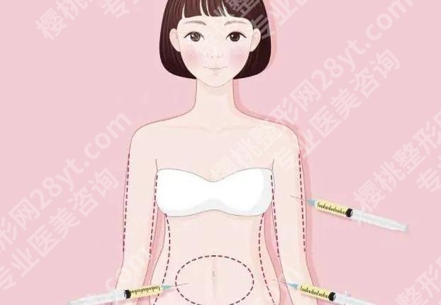 腰腹环吸抽脂需要多久恢复期|多会可以消肿呢？收费表