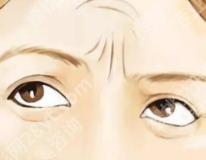 抬头纹去除手术需要多少钱？除皱方式有哪些？那种可靠
