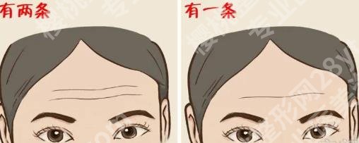 抬头纹去除手术需要多少钱？除皱方式有哪些？那种可靠