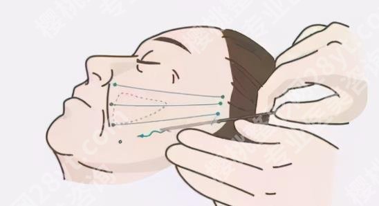 打紧致提升针有用吗？主要功效是什么？注意事项曝光