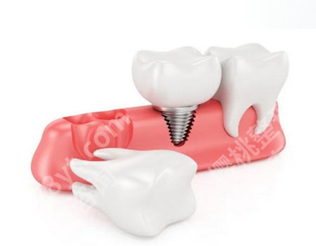 种牙便宜多少钱一颗啊？种植牙的费用相对较高！