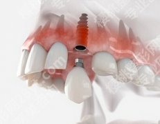 种一颗牙大概需要多少钱？2023种植牙的费用通常包括以下几个方面！