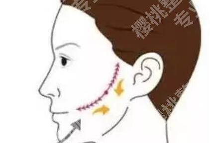 筋膜悬吊术适合多大年龄的？大概需要多少钱？有什么作用吗？